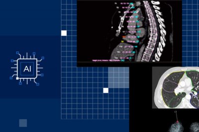 AI và Xeon: Sự kết hợp giúp tăng tốc quá trình điều trị ung thư